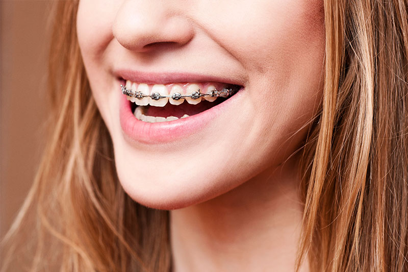 Orthodontics in San Francisco